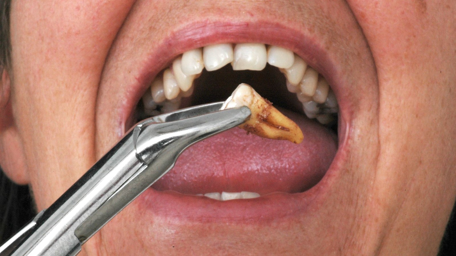 Tooth Extraction
