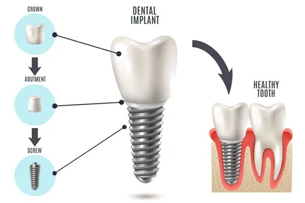 Dental Implants